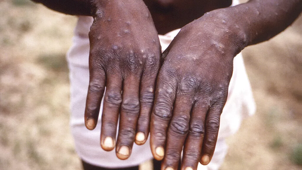 Kenya And The Central African Republic Have Confirmed Mpox Outbreaks