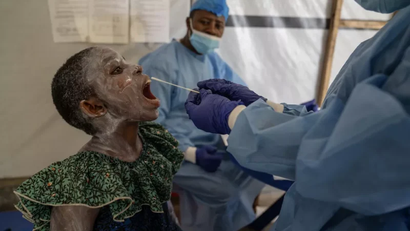 Outbreak of Mpox: DR Congo is Overcrowded and Faces Significant Medication Shortages